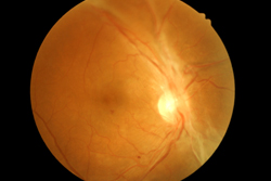 An image of a retina with an eye disease
